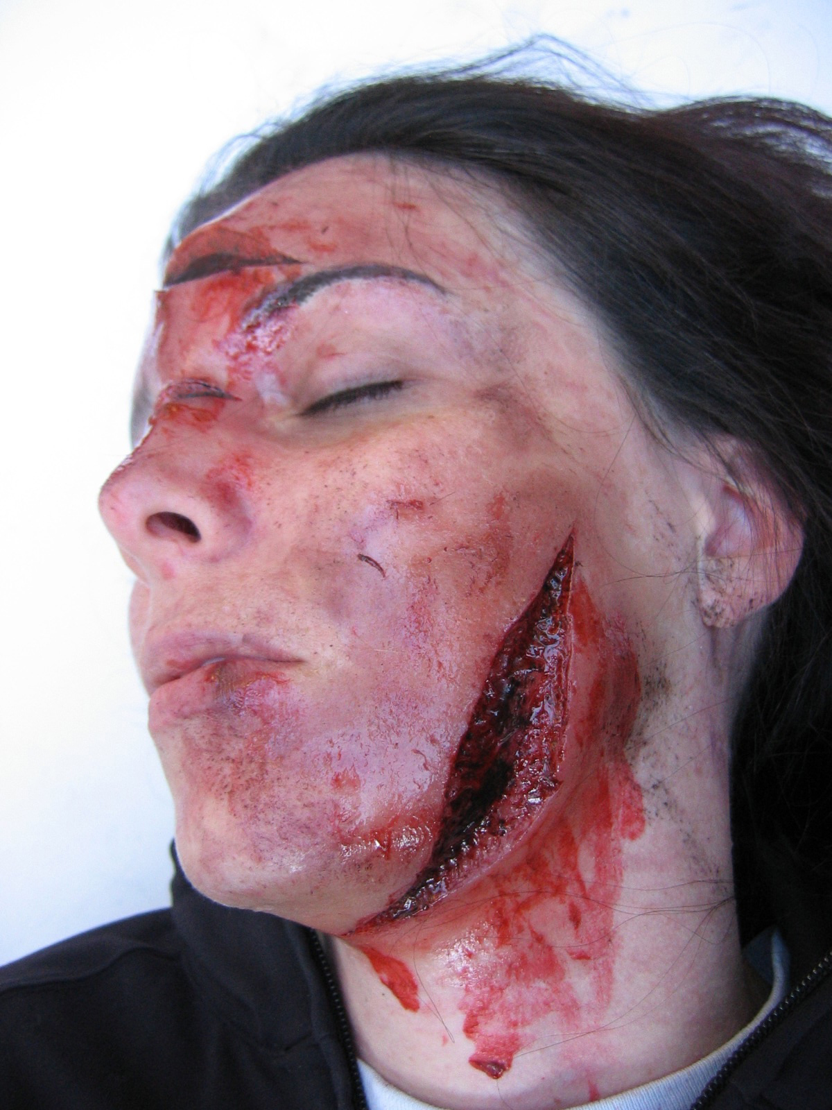 Facial Lacerations 52