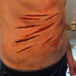 #4 Multiple Abdominal Lacerations (1 appliance)